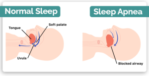 Normal Sleep Sleep Apnea